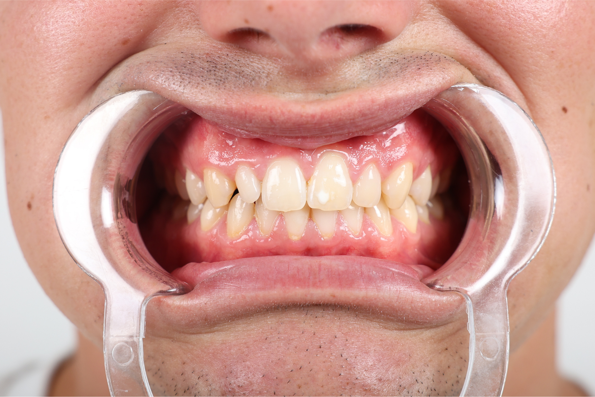 Before E-max Laminate Treatment